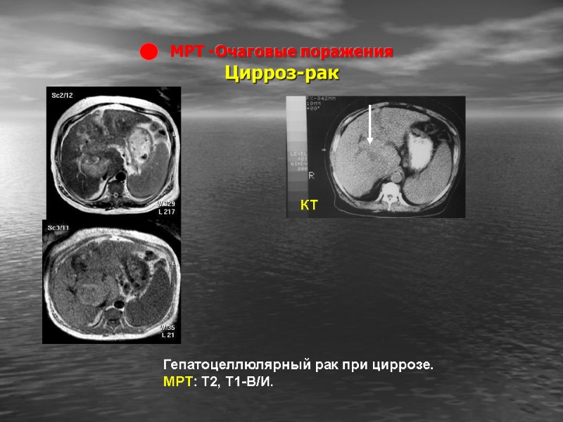 МРТ -Очаговые поражения  Цирроз-рак Гепатоцеллюлярный рак при циррозе. МРТ: Т2, Т1-В/И. КТ